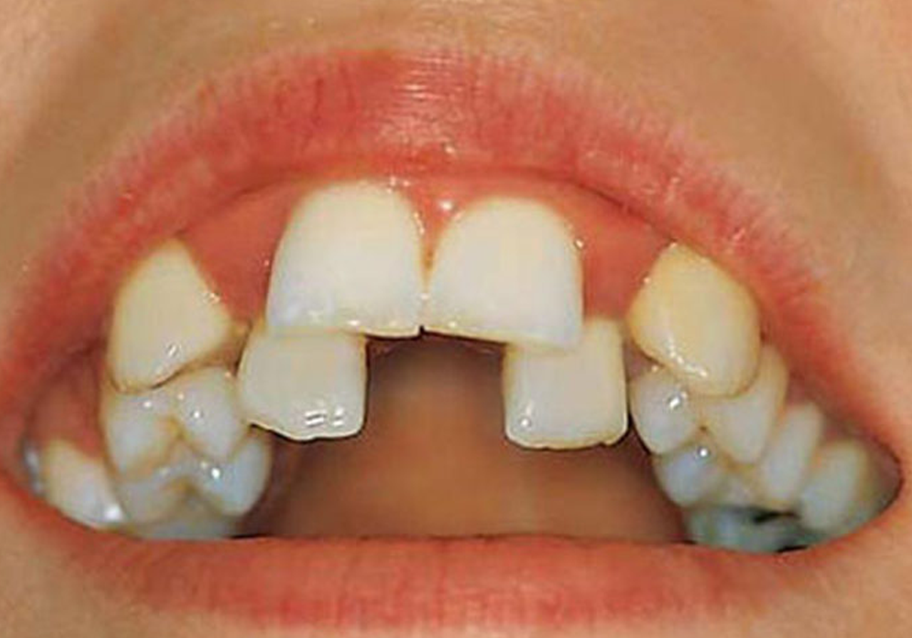 Çapraşık Dişler Nasıl Düzelir? Modern Ortodontik Tedavi Yöntemleri