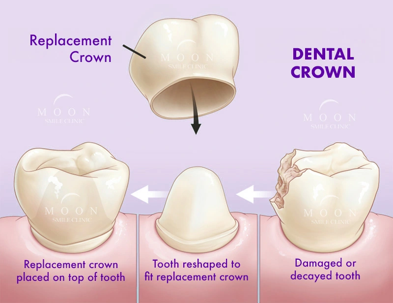 Dental Crowns: Types, Procedure & Care - Dental Crown in Turkey