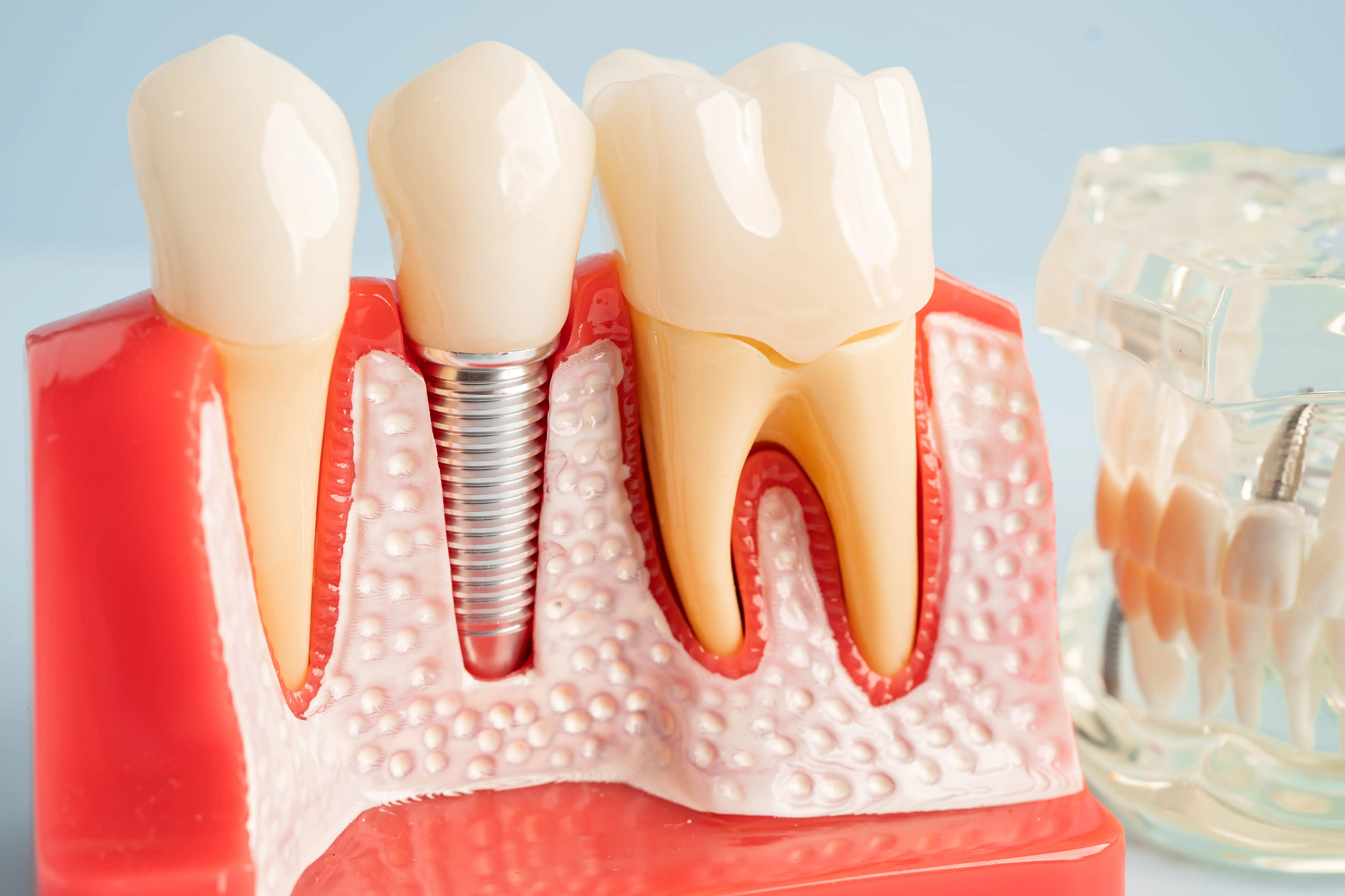 Dental Implants in Antalya: Cost, Procedures, and Packages