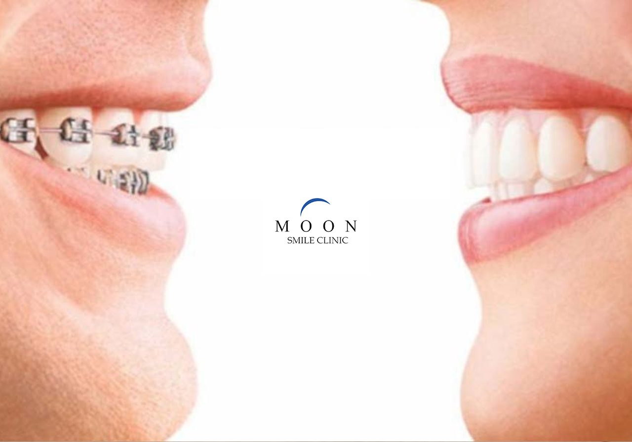 Diş Teli mi Şeffaf Plak mı? Sizin İçin Hangisi Doğru?