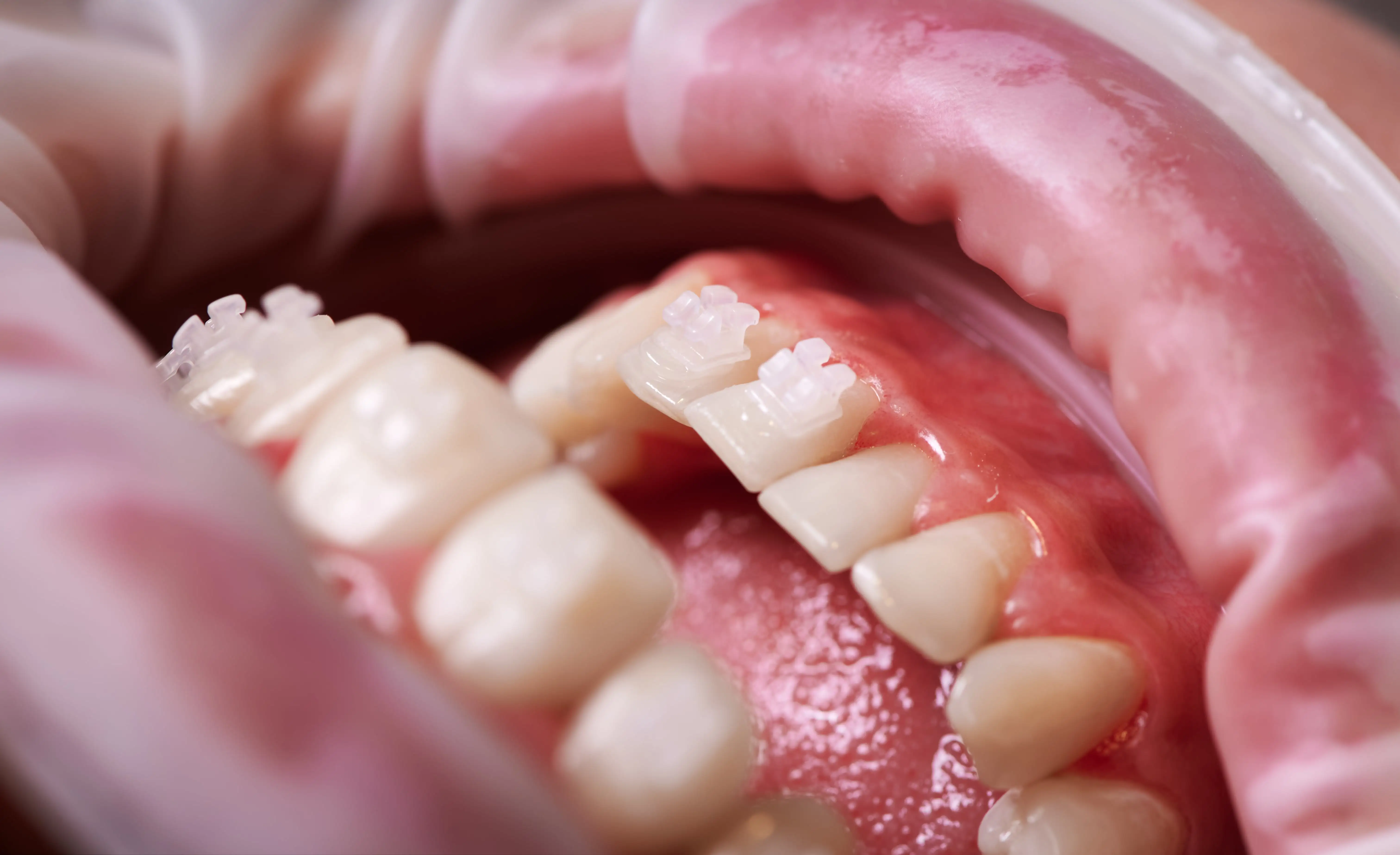 Gum Disease (Periodontal Disease), Symptoms and Causes Gum Disease (Periodontal Disease), Symptoms and Causes