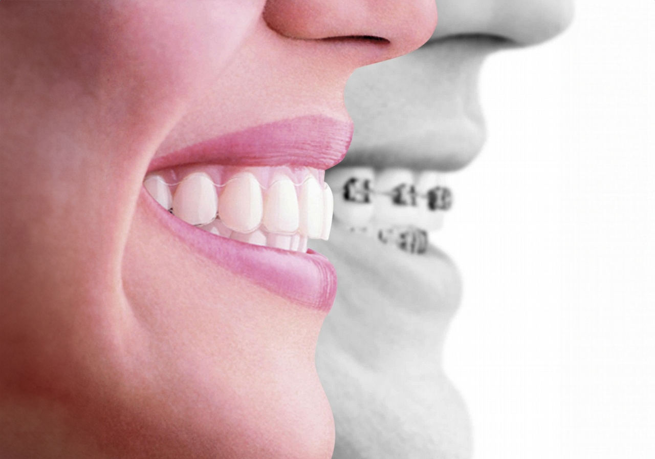 Ortodonti Tedavisi A'dan Z'ye: Süreç, Çeşitler ve Fiyatlar