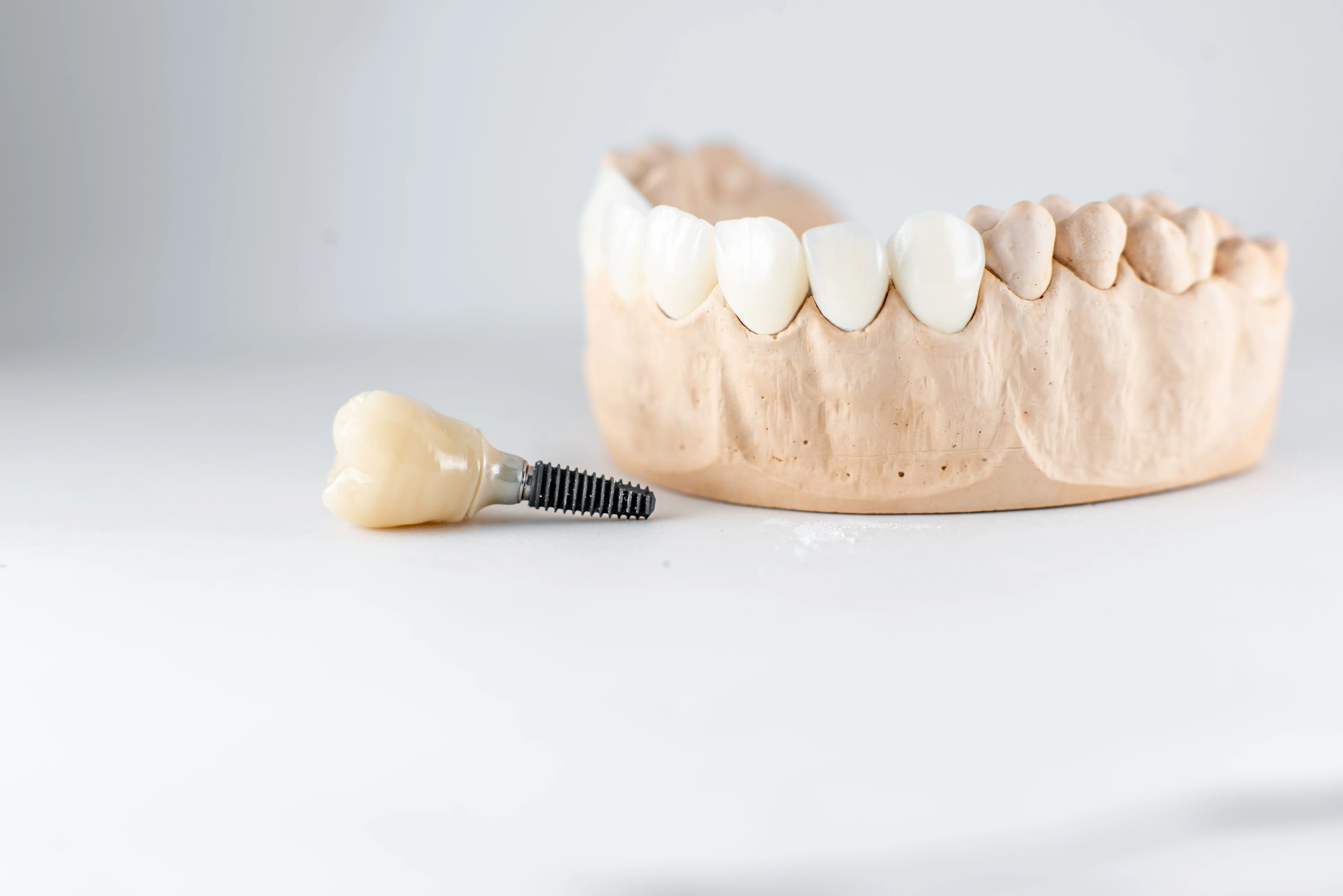 Types of Dental Implants: Explanation and Applications