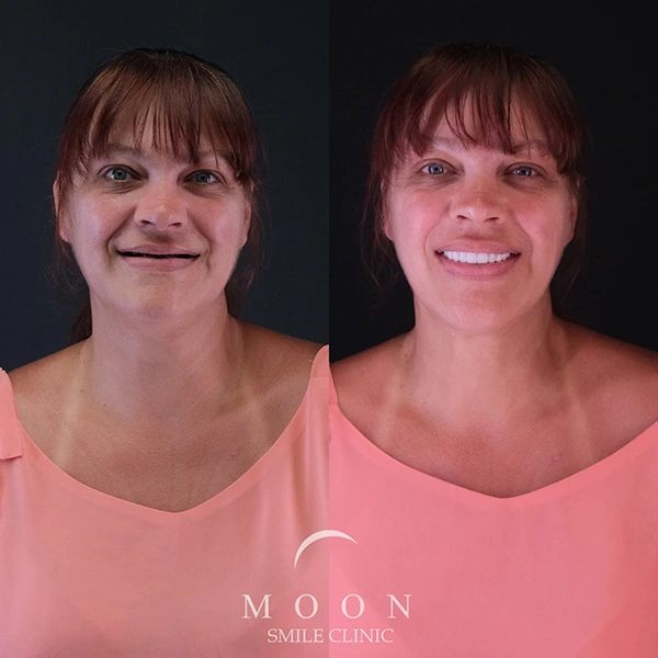 Moon Smile Clinic Dental Implants Moon Smile Clinic Dental Implants