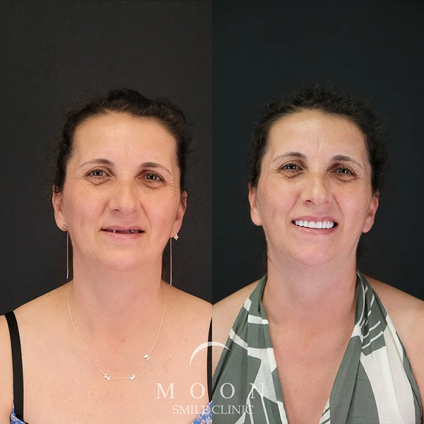 Moon Smile Clinic Dental Implants Moon Smile Clinic Dental Implants
