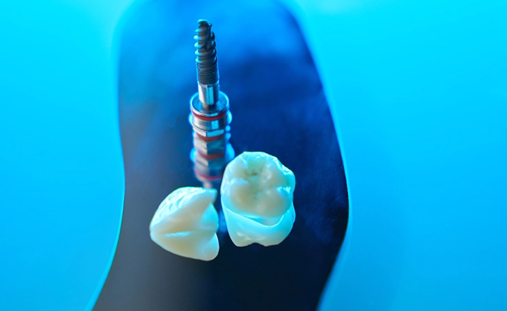 dental-implant